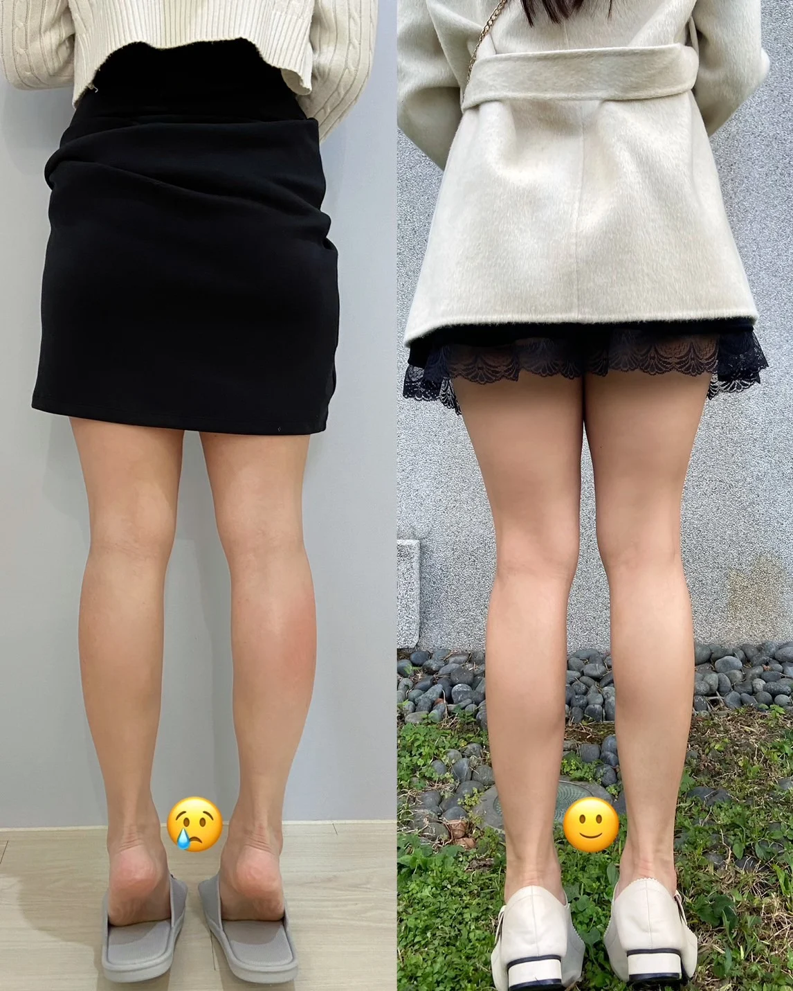 肉毒小腿