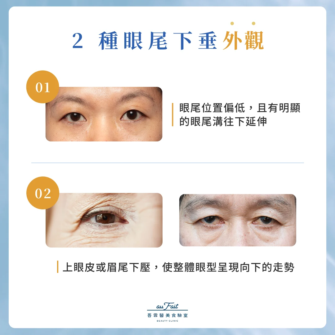 2 種眼尾下垂外觀
