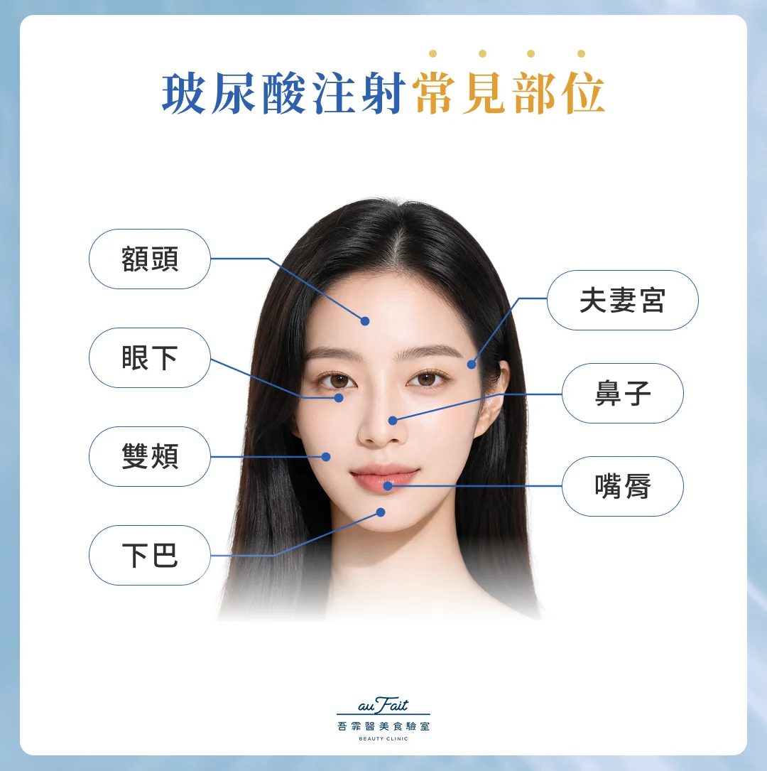 玻尿酸注射常見部位